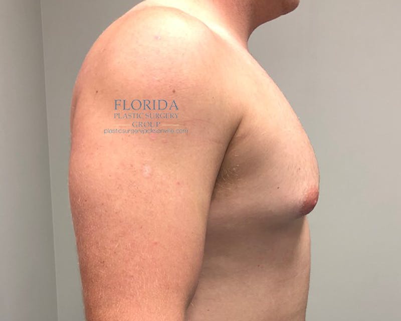 Male Breast Reduction Before & After Gallery - Patient 154948684 - Image 3