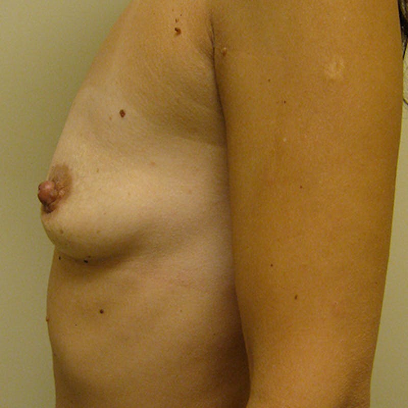 Saline Breast Augmentation Before & After Gallery - Patient 154948683 - Image 3