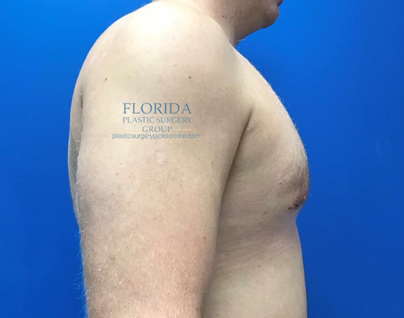 Male Breast Reduction Before & After Gallery - Patient 154948684 - Image 4