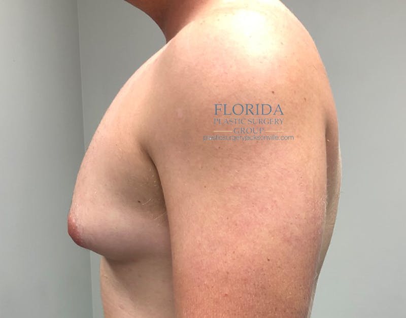 Male Breast Reduction Before & After Gallery - Patient 154948684 - Image 5
