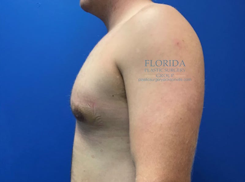 Male Breast Reduction Before & After Gallery - Patient 154948684 - Image 6