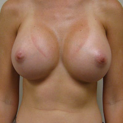 Silicone Breast Augmentation Before & After Gallery - Patient 154948686 - Image 2
