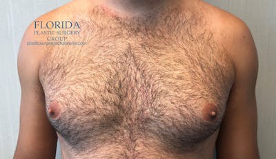 Male Breast Reduction Before & After Gallery - Patient 154948690 - Image 1