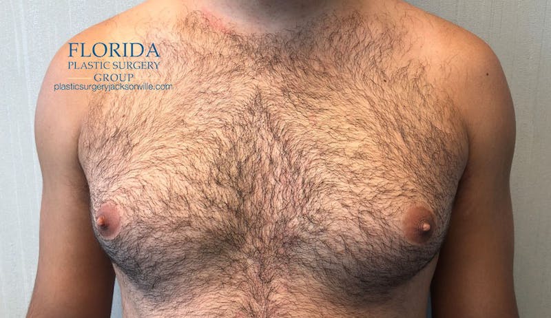 Male Breast Reduction Before & After Gallery - Patient 154948690 - Image 1