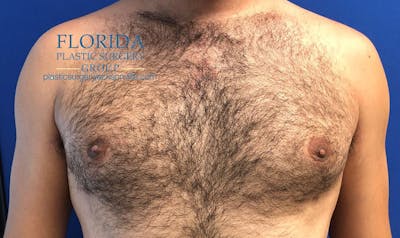 Male Breast Reduction Before & After Gallery - Patient 154948690 - Image 2