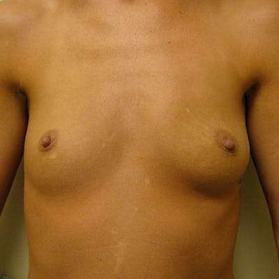 Saline Breast Augmentation Before & After Gallery - Patient 154948691 - Image 1