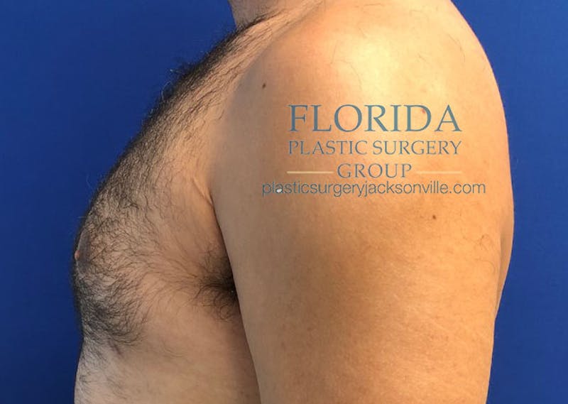 Male Breast Reduction Before & After Gallery - Patient 154948690 - Image 4