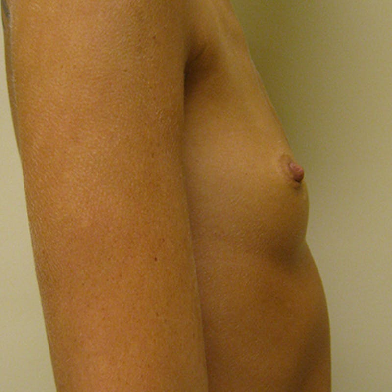 Saline Breast Augmentation Before & After Gallery - Patient 154948691 - Image 5