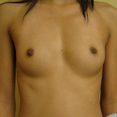 Silicone Breast Augmentation Before & After Gallery - Patient 154948693 - Image 1
