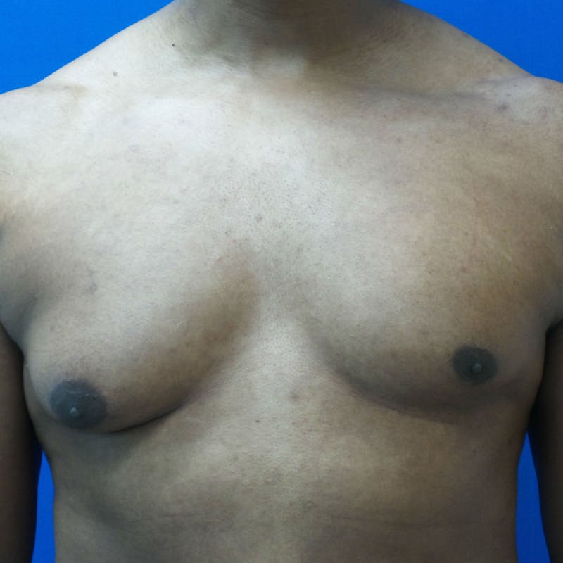 Male Breast Reduction Before & After Gallery - Patient 154948694 - Image 1