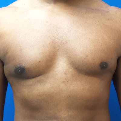 Male Breast Reduction Before & After Gallery - Patient 154948694 - Image 2