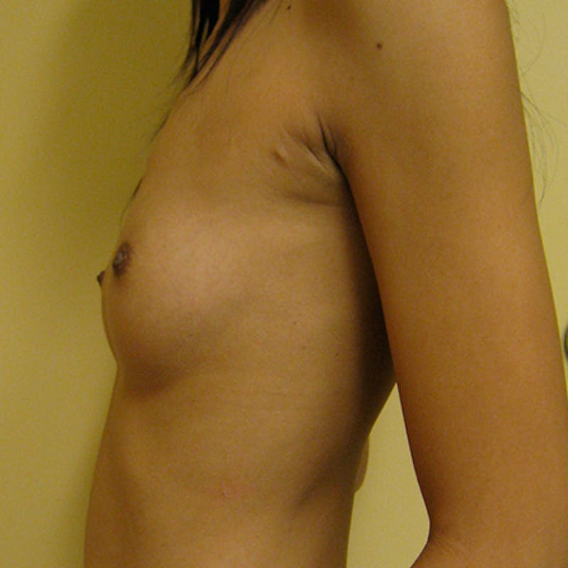Silicone Breast Augmentation Before & After Gallery - Patient 154948693 - Image 3