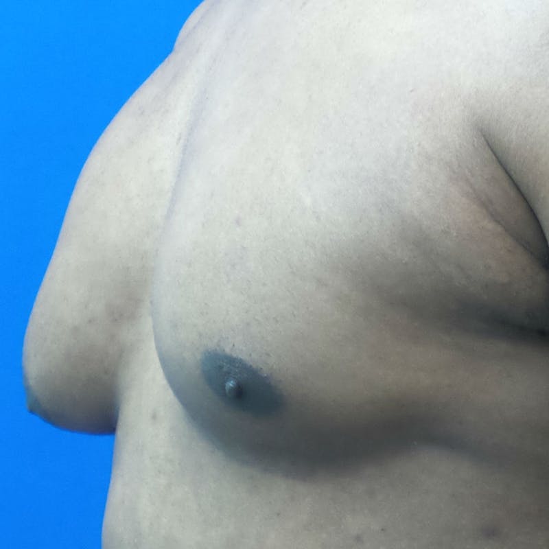 Male Breast Reduction Before & After Gallery - Patient 154948694 - Image 3