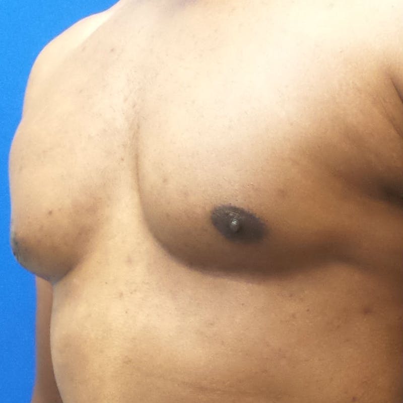 Male Breast Reduction Before & After Gallery - Patient 154948694 - Image 4