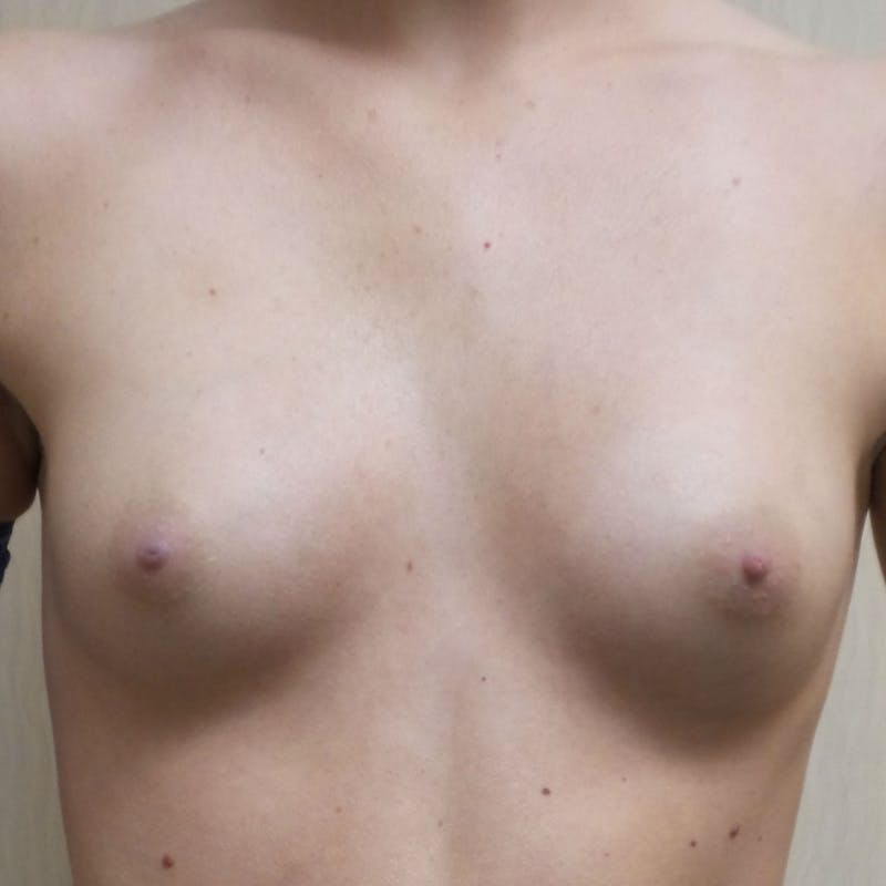 Silicone Breast Augmentation Before & After Gallery - Patient 154948696 - Image 1