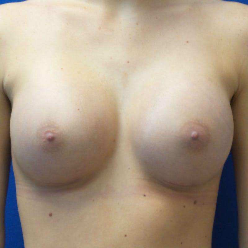 Silicone Breast Augmentation Before & After Gallery - Patient 154948696 - Image 2