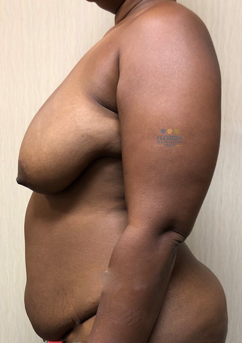 Augmentation Mastopexy Before & After Gallery - Patient 154948697 - Image 3