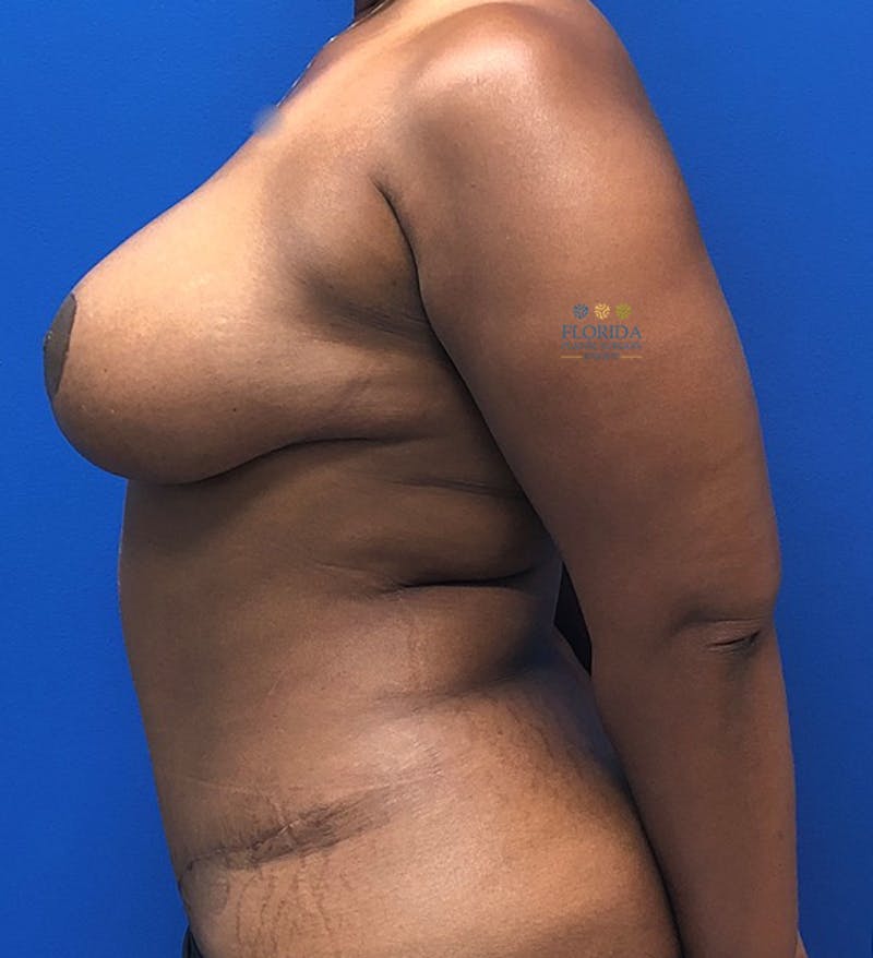 Augmentation Mastopexy Before & After Gallery - Patient 154948697 - Image 4