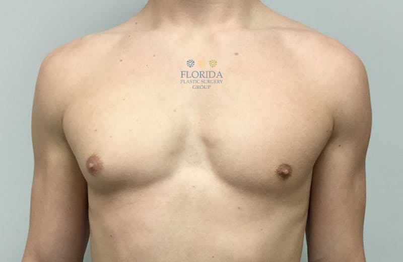 Male Breast Reduction Before & After Gallery - Patient 154948701 - Image 1