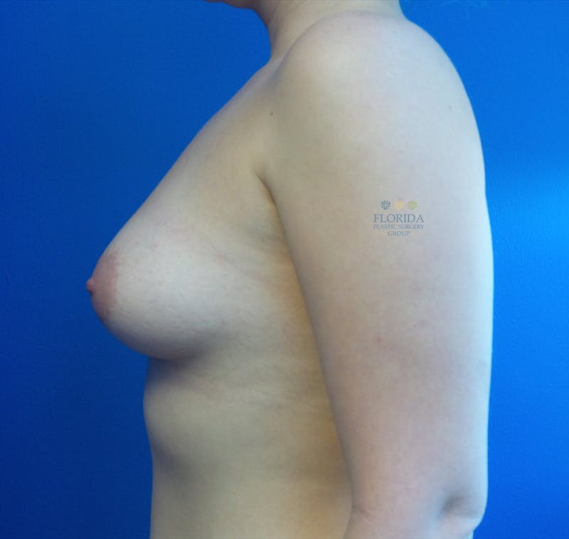 Saline Breast Augmentation Before & After Gallery - Patient 154948698 - Image 5