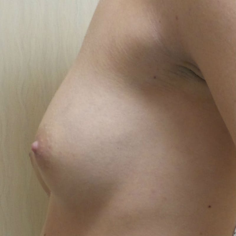 Silicone Breast Augmentation Before & After Gallery - Patient 154948696 - Image 5