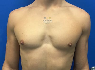 Male Breast Reduction Before & After Gallery - Patient 154948701 - Image 2