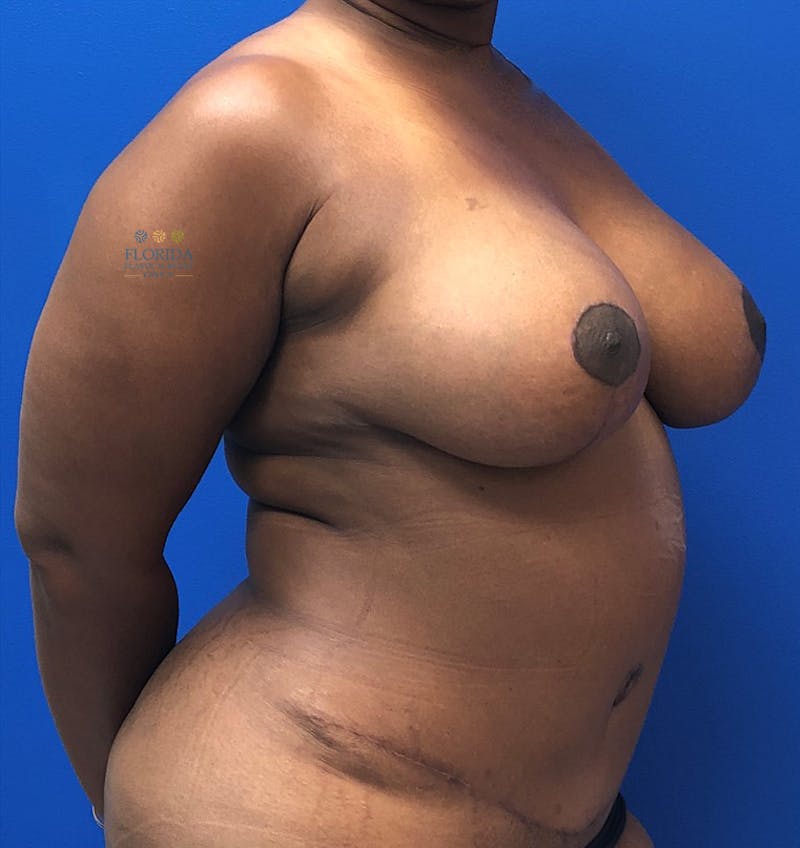 Augmentation Mastopexy Before & After Gallery - Patient 154948697 - Image 6