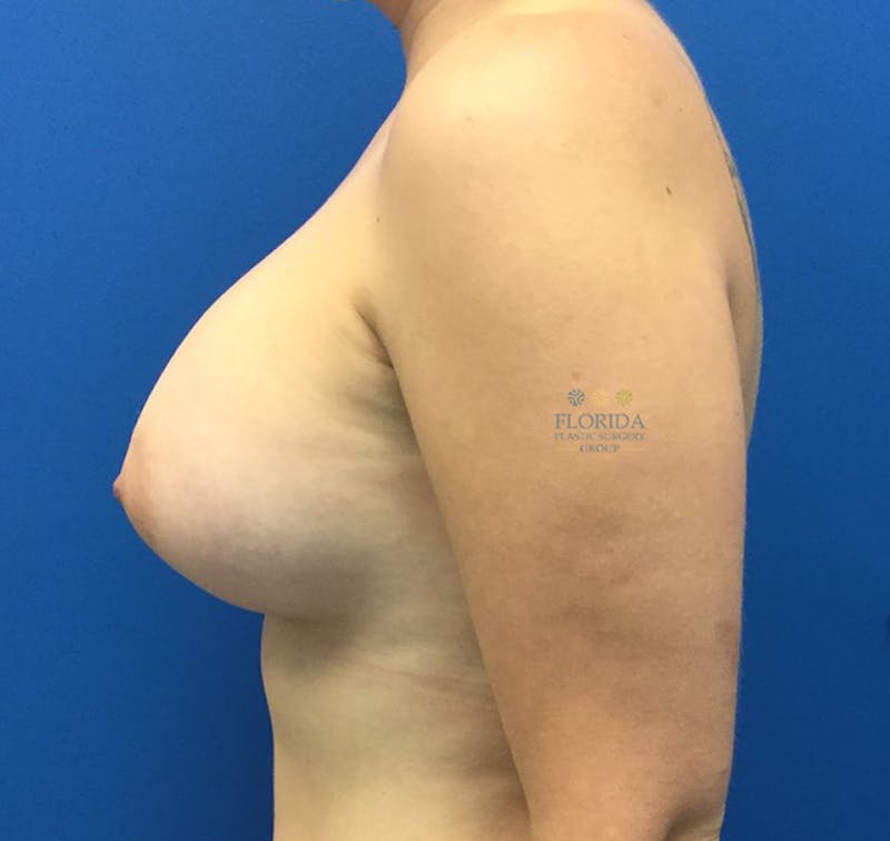 Saline Breast Augmentation Before & After Gallery - Patient 154948698 - Image 6
