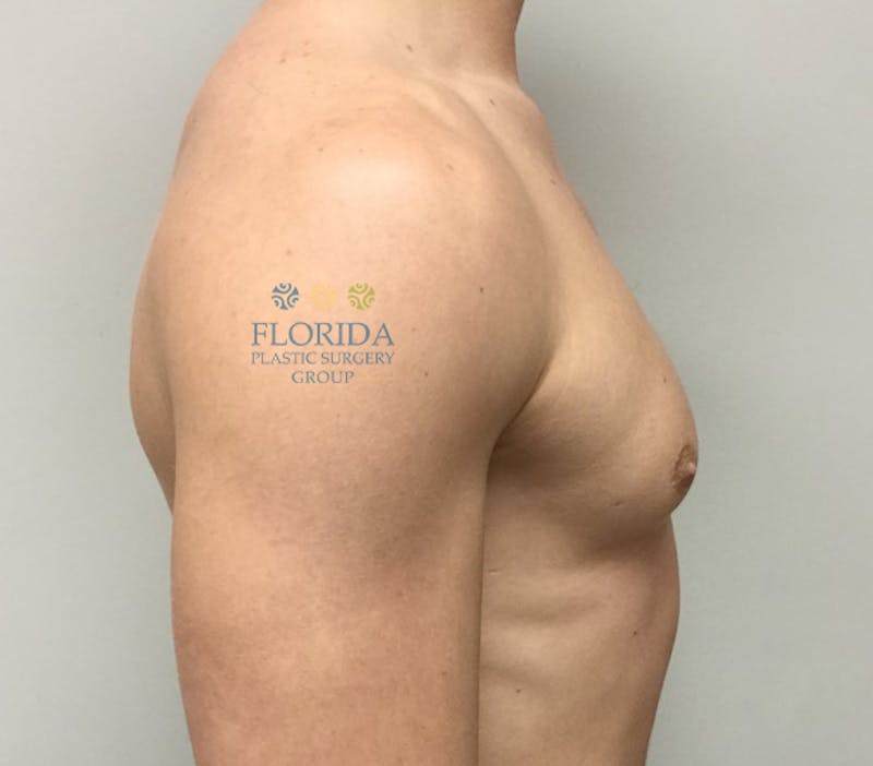 Male Breast Reduction Before & After Gallery - Patient 154948701 - Image 3