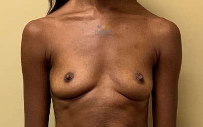 Silicone Breast Augmentation Before & After Gallery - Patient 154948705 - Image 1