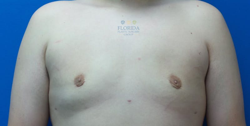 Male Breast Reduction Before & After Gallery - Patient 154948706 - Image 2