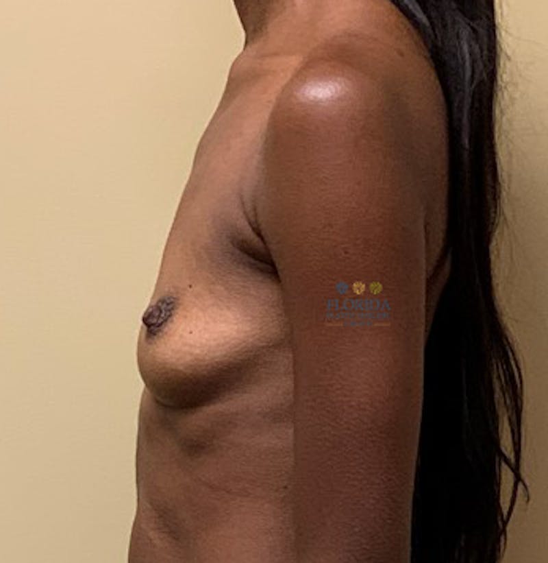 Silicone Breast Augmentation Before & After Gallery - Patient 154948705 - Image 5