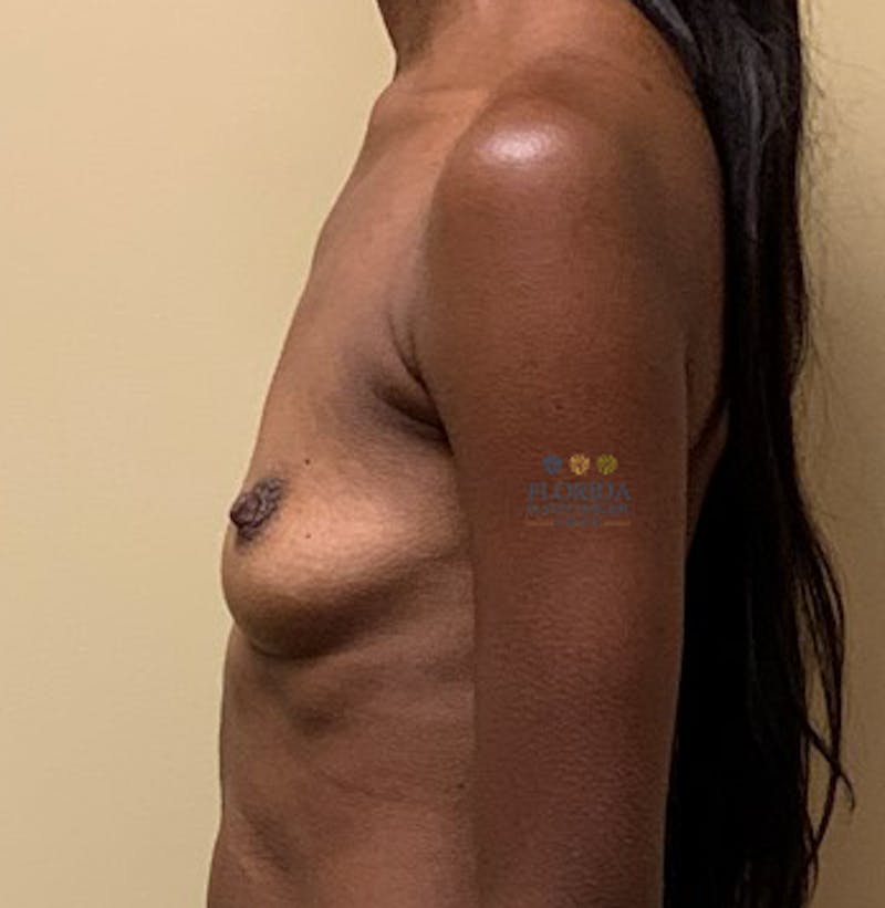 Silicone Breast Augmentation Before & After Gallery - Patient 154948705 - Image 5