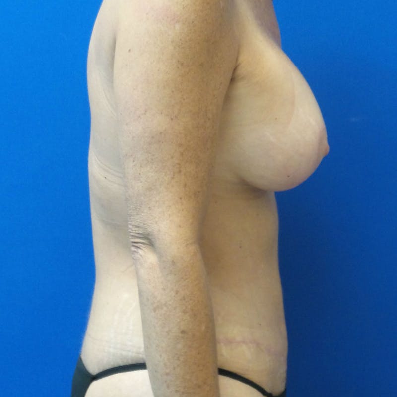 Augmentation Mastopexy Before & After Gallery - Patient 154948703 - Image 6