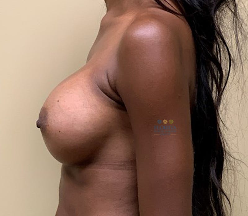 Silicone Breast Augmentation Before & After Gallery - Patient 154948705 - Image 6
