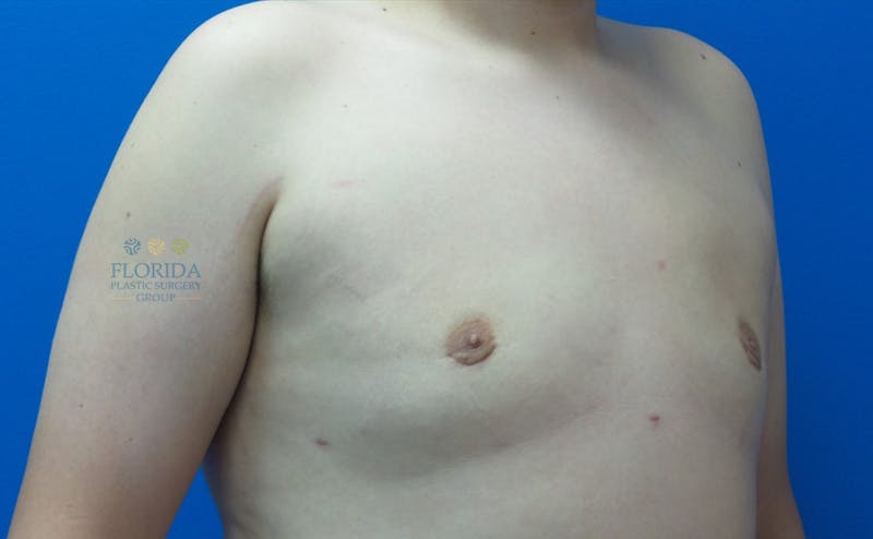 Male Breast Reduction Before & After Gallery - Patient 154948706 - Image 4