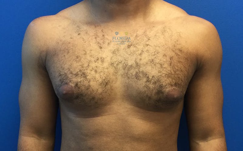 Male Breast Reduction Before & After Gallery - Patient 154948713 - Image 1