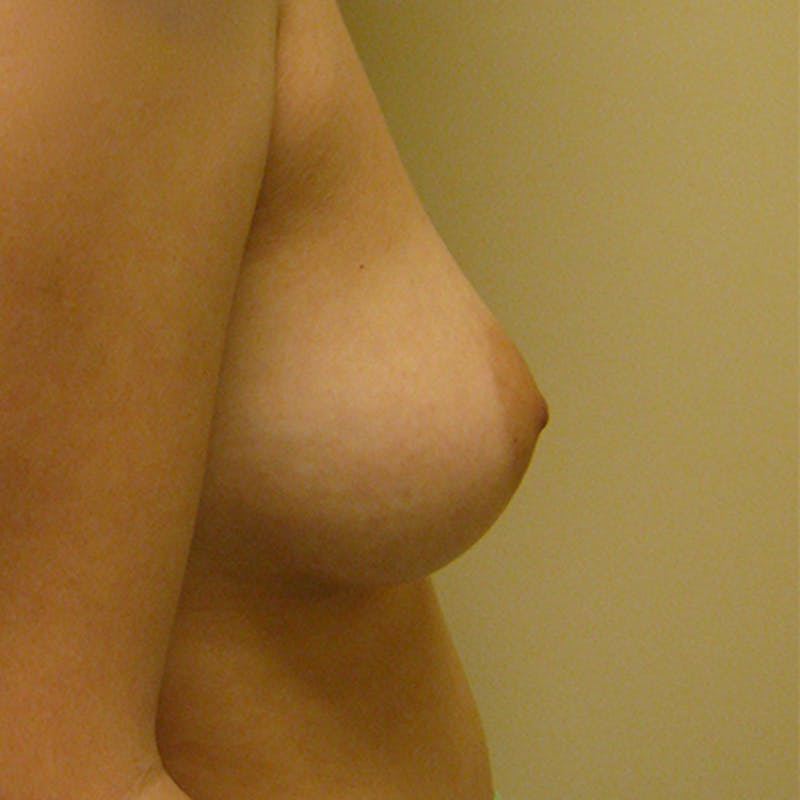 Saline Breast Augmentation Before & After Gallery - Patient 154948710 - Image 3