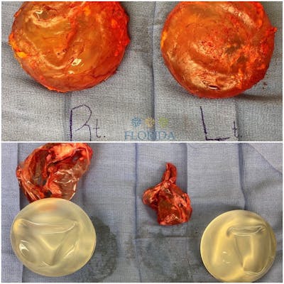 Breast Implant Removal Before & After Gallery - Patient 154948707 - Image 2
