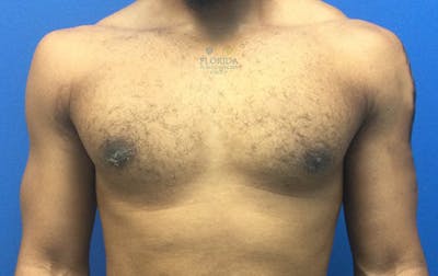 Male Breast Reduction Before & After Gallery - Patient 154948713 - Image 2