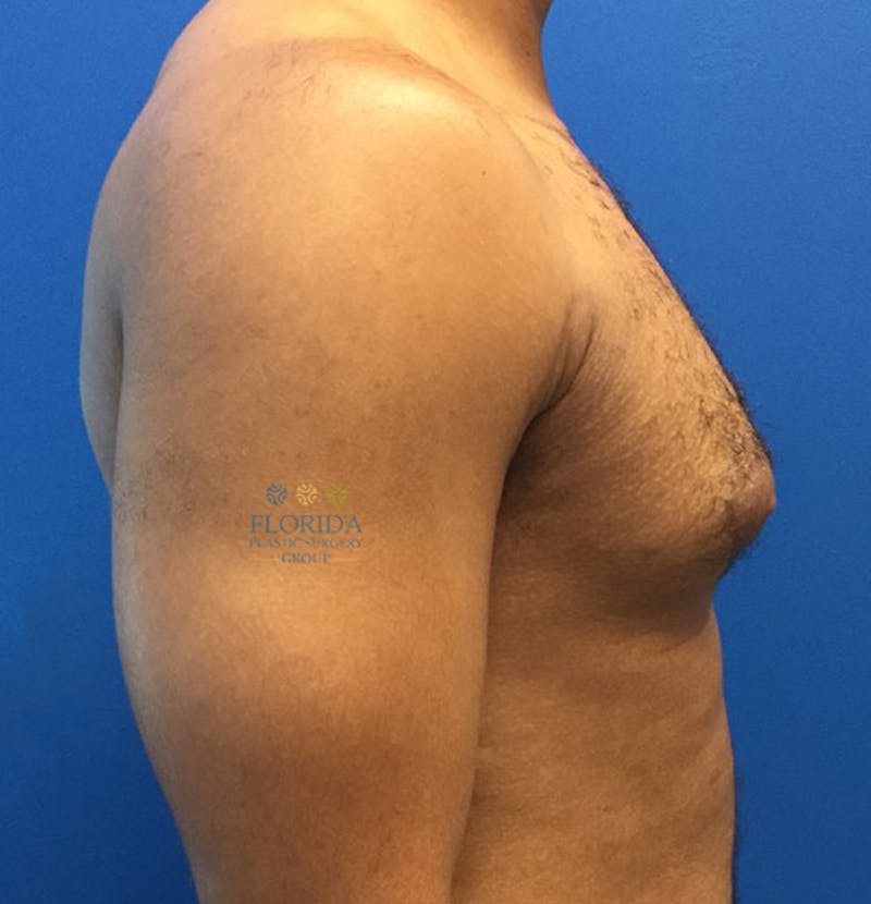 Male Breast Reduction Before & After Gallery - Patient 154948713 - Image 3