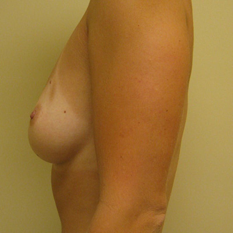 Silicone Breast Augmentation Before & After Gallery - Patient 154948714 - Image 3