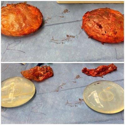 Breast Implant Removal Before & After Gallery - Patient 154948711 - Image 2
