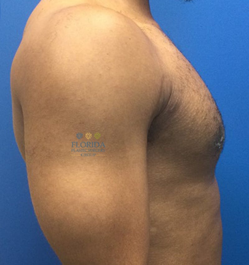 Male Breast Reduction Before & After Gallery - Patient 154948713 - Image 4