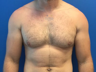 Male Breast Reduction Before & After Gallery - Patient 154948730 - Image 1
