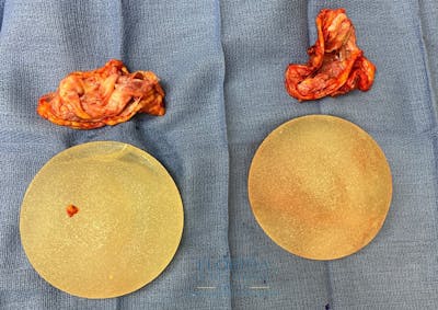 Breast Implant Removal Before & After Gallery - Patient 154948720 - Image 2