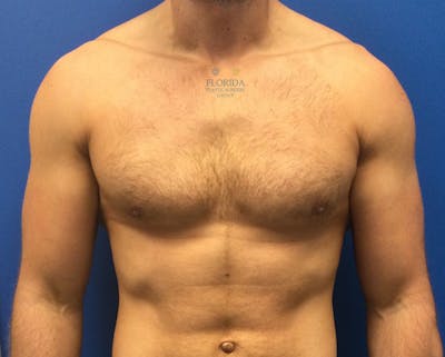 Male Breast Reduction Before & After Gallery - Patient 154948730 - Image 2