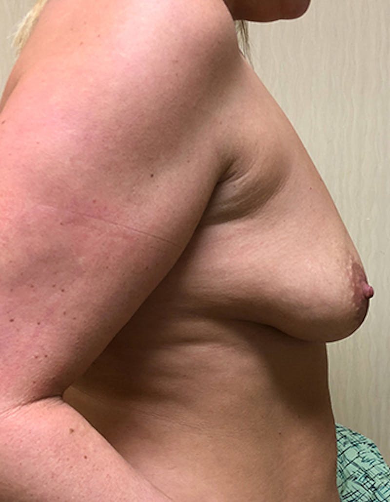 Augmentation Mastopexy Before & After Gallery - Patient 154948727 - Image 3