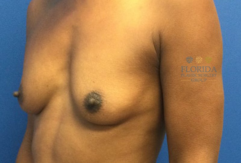 Silicone Breast Augmentation Before & After Gallery - Patient 154948719 - Image 3
