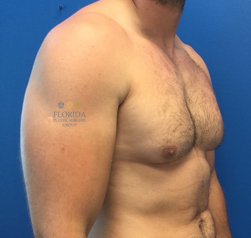 Male Breast Reduction Before & After Gallery - Patient 154948730 - Image 3